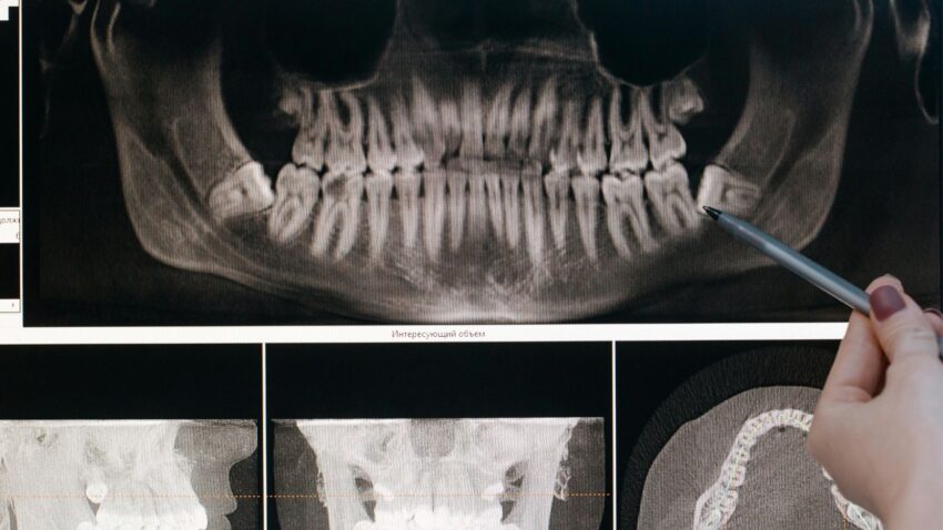 Bölcsességfog eltávolítása a MyDent fogorvos Budapesten